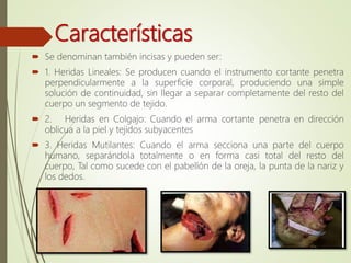 Características
 Se denominan también incisas y pueden ser:
 1. Heridas Lineales: Se producen cuando el instrumento cortante penetra
perpendicularmente a la superficie corporal, produciendo una simple
solución de continuidad, sin llegar a separar completamente del resto del
cuerpo un segmento de tejido.
 2. Heridas en Colgajo: Cuando el arma cortante penetra en dirección
oblicua a la piel y tejidos subyacentes
 3. Heridas Mutilantes: Cuando el arma secciona una parte del cuerpo
humano, separándola totalmente o en forma casi total del resto del
cuerpo, Tal como sucede con el pabellón de la oreja, la punta de la nariz y
los dedos.
 