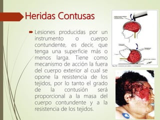 Heridas Contusas
 Lesiones producidas por un
instrumento o cuerpo
contundente, es decir, que
tenga una superficie más o
menos larga. Tiene como
mecanismo de acción la fuera
del cuerpo exterior al cual se
opone la resistencia de los
tejidos, por lo tanto el grado
de la contusión será
proporcional a la masa del
cuerpo contundente y a la
resistencia de los tejidos.
 