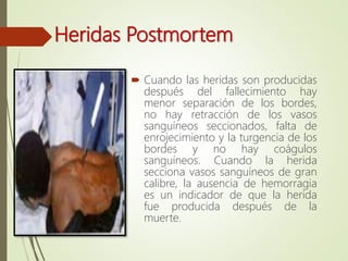 Heridas Postmortem
 Cuando las heridas son producidas
después del fallecimiento hay
menor separación de los bordes,
no hay retracción de los vasos
sanguíneos seccionados, falta de
enrojecimiento y la turgencia de los
bordes y no hay coágulos
sanguíneos. Cuando la herida
secciona vasos sanguíneos de gran
calibre, la ausencia de hemorragia
es un indicador de que la herida
fue producida después de la
muerte.
 