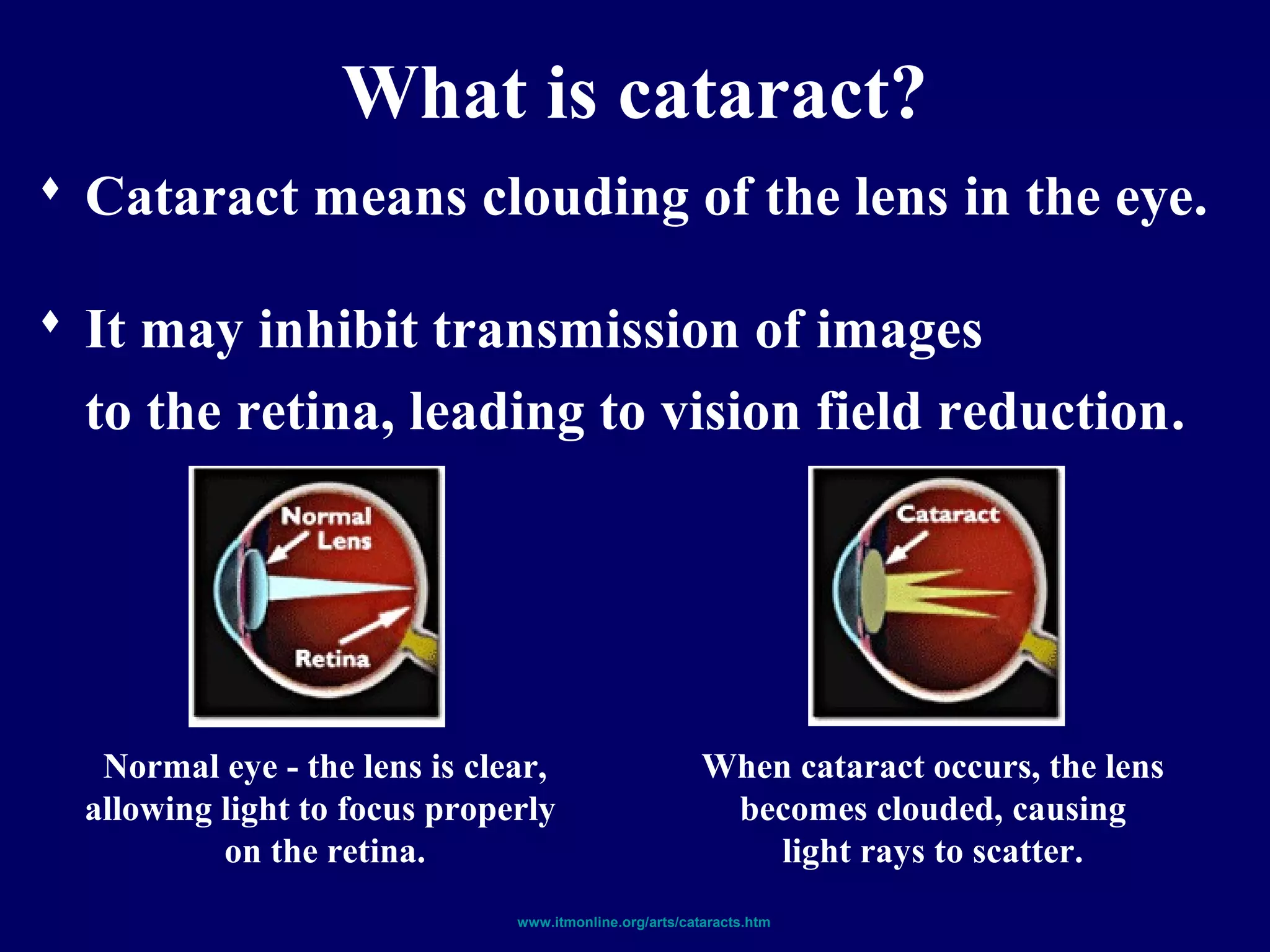 Medicinal plants the future in cataract therapy
