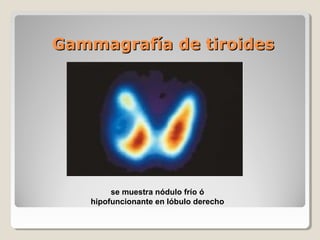 Gammagrafía de tiroidesGammagrafía de tiroides
se muestra nódulo frío ó
hipofuncionante en lóbulo derecho
 