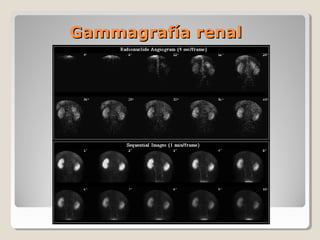 Gammagrafía renalGammagrafía renal
 