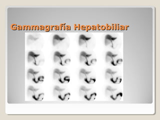 Gammagrafía HepatobiliarGammagrafía Hepatobiliar
 