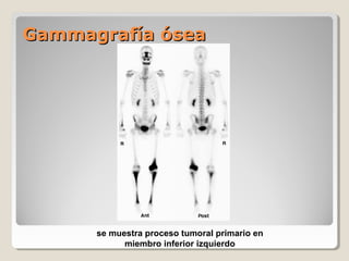 Gammagrafía óseaGammagrafía ósea
se muestra proceso tumoral primario en
miembro inferior izquierdo
 