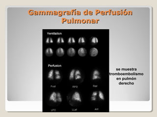 Gammagrafía de PerfusiónGammagrafía de Perfusión
PulmonarPulmonar
se muestra
tromboembolismo
en pulmón
derecho
 