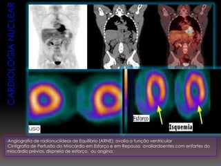 •Angiografia de radionuclídeos de Equilíbrio (ARNE): avalia a função ventricular
•Cintigrafia de Perfusão do Miocárdio em Esforço e em Repouso avaliardoentes com enfartes do
miocárdio prévios, dispneia de esforço, ou angina.
 