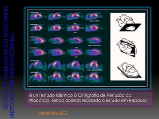 é um estudo idêntico à Cintigrafia de Perfusão do
Miocárdio, sendo apenas realizado o estudo em Repouso
BrightView XCT
 