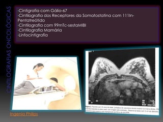 •Cintigrafia com Gálio-67
•Cintilografia dos Receptores da Somatostatina com 111In-
Pentatreótido
•Cintilografia com 99mTc-sestaMIBI
•Cintilografia Mamária
•Linfocintigrafia
Ingenia Philips
 