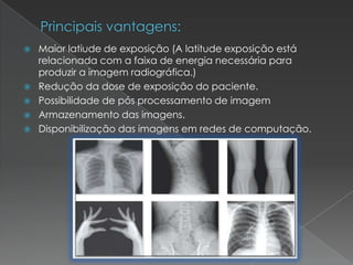  Maior latiude de exposição (A latitude exposição está
relacionada com a faixa de energia necessária para
produzir a imagem radiográfica.)
 Redução da dose de exposição do paciente.
 Possibilidade de pós processamento de imagem
 Armazenamento das imagens.
 Disponibilização das imagens em redes de computação.
 