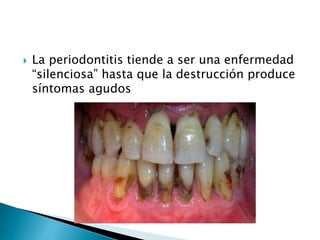  La periodontitis tiende a ser una enfermedad
“silenciosa” hasta que la destrucción produce
síntomas agudos
 