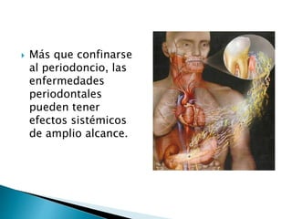  Más que confinarse
al periodoncio, las
enfermedades
periodontales
pueden tener
efectos sistémicos
de amplio alcance.
 