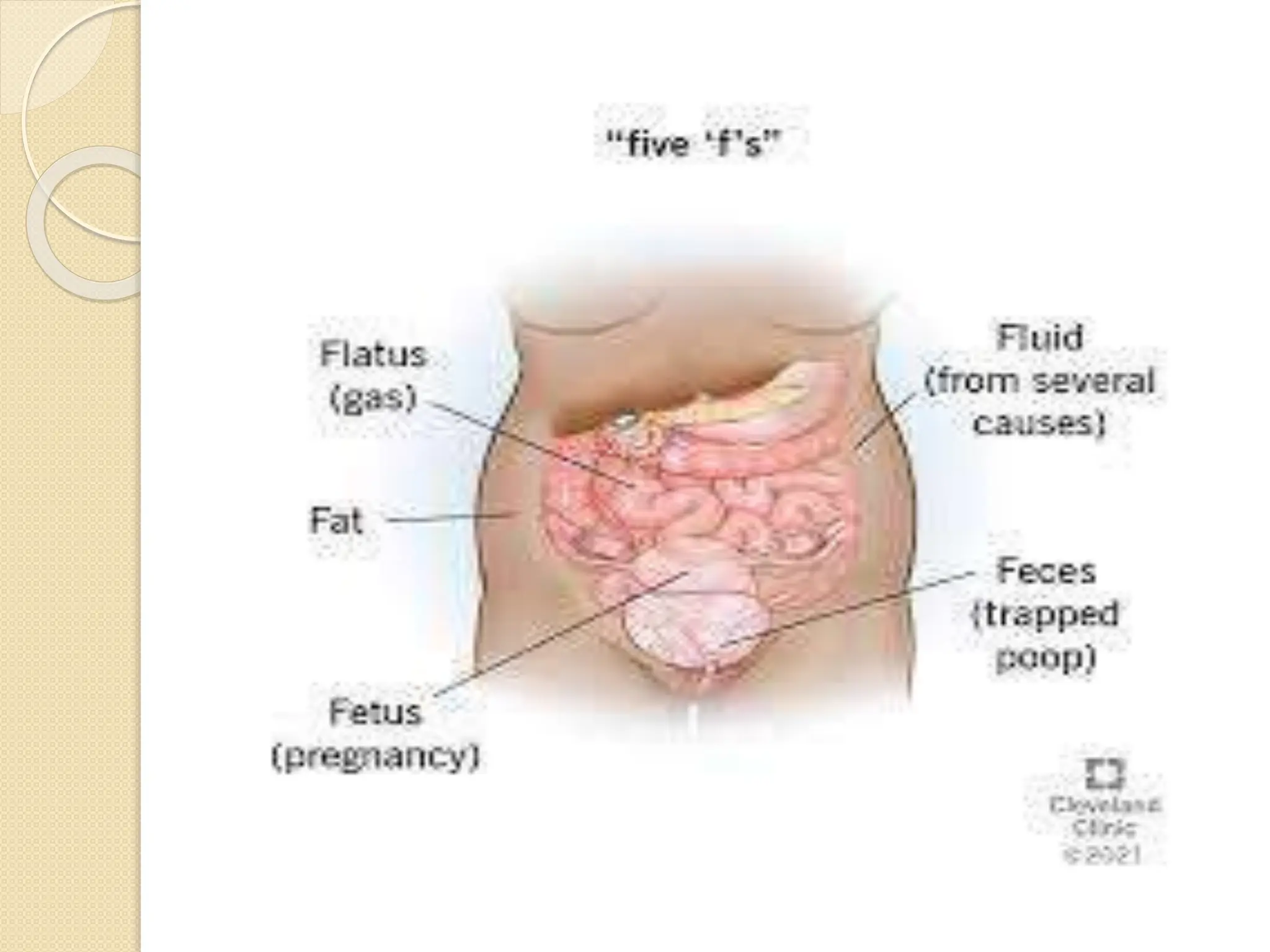 MEDICINE - DISTENDED ABDOMEN.with examplespptx | PPTX