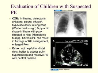 Evaluation of Children with Suspected
PE
Source Unknown

 

 

CXR: infiltrates, atelectasis,
unilateral pleural effusion,
hypovascularity in lung zone
(Westermark’s sign) & pyramid
shape infiltrate with peak
directed to hilus (Hampton’s
hump). Chronic PE can result
in findings of RH enlargement,
enlarged PA’s.
Echo: not helpful for distal
clots, better to assess pulm
hypertension and massive PE
with central position.

Source Unknown

Source Unknown

 