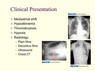 Clinical Presentation
Source Unknown

  Mediastinal shift
  Hypoalbinemia
  Thromobcytosis
  Hypoxia
  Radiology:
 
 
 
 

Plain films
Decubitus films
Ultrasound
Chest CT
Source Unknown
Source Unknown

 