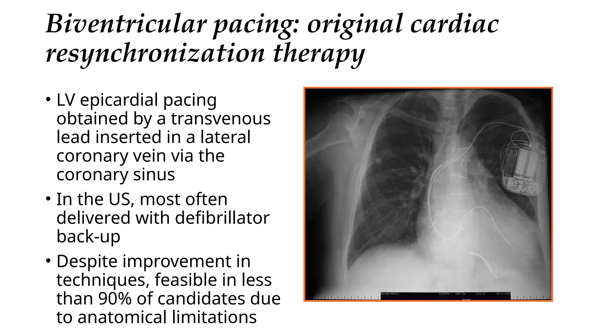 Picture of Review of conduction system pacing | PPTX