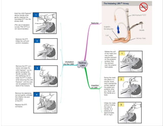 fasttrac
LMA
features
insertion
of LMA
intubation
via the LMA
 
