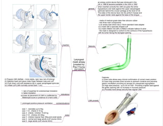 Laryngeal
mask airway
[created by
Paul Young
22/12/07]
features
- made of medical-grade latex-free silicone rubber
- has three main components:
1) an airway tube which has a 15mm standard male adapter
2) a mask with a specially shaped cuff
3) a mask inflation line with a inflation indicator balloon & valve
- the mask is designed to conform to the contours of the hypopharynx
with its lumen facing the laryngeal opening
general
an airway control device that was introduced in the
UK in 1988 & became available in the USA in 1992
when inserted correctly the LMA occupies the entire
hypopharynx and rests against the upper oesophageal
sphincter behind the cricoid cartilage at the level of C6.
The sides of the device face into the piriform fossae and
the upper border rests against the base of the tongue
indications
1. lack of expertise for endotracheal intubation
2. failed intubation
success at placement of LMA is unaffected by
Mallampati score or presence of a hard collar
sizes
size 1 - neonates up to 5kg
size 1 1/2 - infants 5-10 kg
size 2 - infants / children 10-20 kg
size 2 1/2 - children 20-30kg
size 3 - children heavier than 30kg and small adults
size 4 - normal and large adults (cuff volume 30ml)
size 5 - large adults (cuff volume 40ml)
contraindications1. prolonged positive pressure ventilation
LMA proseal
Features:
(i) Drain tube allows easy clinical confirmation of correct mask position
(ii) Drain tube provides direct access to stomach contents and prevents
gastric insufflation providing an escape for unexpected regurgitation
(iii) High seal pressure - up to 30 cm H20 - Providing a tighter seal against
the glottic opening with no increase in mucosal pressure
(iv) Provides more airway security than regular LMA
insertion
soft palate teeth
tongue
larynx
esophagus
trachea
soft palate teeth
tongue
larynx
esophagus
trachea
(i) Prepare LMA (deflate – more stable, rigid, less risk of kinking)
(ii) Stabilize head and place Index finger between tube and cuff
(iii) Push down until soft resistance (tip in upper oerophageal sphincter
(iv) Inflate cuff (LMA normally comes back 1 cm)
 
