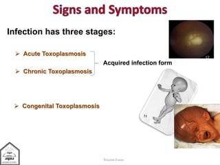  Chronic Toxoplasmosis
12
 Acute Toxoplasmosis
Souzan Eassa
 Congenital Toxoplasmosis
Infection has three stages:
Acquired infection form
 