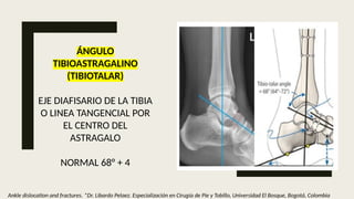 Angulo Tobillo mediciones radiograficas 2 jjnajssadjjajsd | PPTX