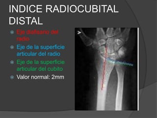 INDICE RADIOCUBITAL 
DISTAL 
 Eje diafisario del 
radio 
 Eje de la superficie 
articular del radio 
 Eje de la superficie 
articular del cubito 
 Valor normal: 2mm 
 