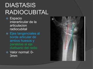 DIASTASIS 
RADIOCUBITAL 
 Espacio 
interarticular de la 
articulacion 
radiocubital 
 Ejes tangenciales al 
borde articular de 
ambos huesos y 
paralelas al eje 
diafisario del radio 
 Valor normal: 0- 
3mm 
 