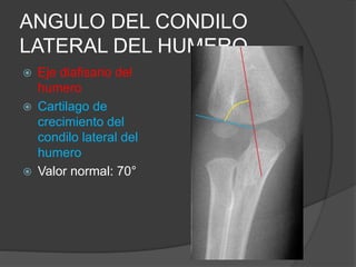 ANGULO DEL CONDILO 
LATERAL DEL HUMERO 
 Eje diafisario del 
humero 
 Cartilago de 
crecimiento del 
condilo lateral del 
humero 
 Valor normal: 70° 
 