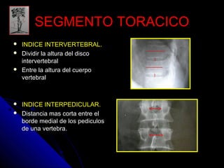 SSEEGGMMEENNTTOO TTOORRAACCIICCOO 
 IINNDDIICCEE IINNTTEERRVVEERRTTEEBBRRAALL.. 
 DDiivviiddiirr llaa aallttuurraa ddeell ddiissccoo 
iinntteerrvveerrtteebbrraall 
 EEnnttrree llaa aallttuurraa ddeell ccuueerrppoo 
vveerrtteebbrraall 
 IINNDDIICCEE IINNTTEERRPPEEDDIICCUULLAARR.. 
 DDiissttaanncciiaa mmaass ccoorrttaa eennttrree eell 
bboorrddee mmeeddiiaall ddee llooss ppeeddiiccuullooss 
ddee uunnaa vveerrtteebbrraa.. 
 