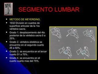 SSEEGGMMEENNTTOO LLUUMMBBAARR 
 MMEETTOODDOO DDEE MMEEYYEERRDDIINNGG.. 
 11993322 DDiivviissiióónn eenn ccuuaarrttooss ddee 
ssuuppeerrffiicciiee aarrttiiccuullaarr ddee llaa 11rraa 
vvéérrtteebbrraa ssaaccrraa.. 
 GGrraaddoo 11.. ddeessppllaazzaammiieennttoo ddeell 44ttoo 
ppoosstteerriioorr ddee llaa vvéérrtteebbrraa ssaaccrraa 00 aa 
225%%.. 
 GGrraaddoo 22.. vvéérrtteebbrraa oolliissttèèttiiccaa ssee 
eennccuueennttrraa eenn eell sseegguunnddoo ccuuaarrttoo 
2266 aa 500%%.. 
 GGrraaddoo 33.. ssee eennccuueennttrraa eenn eell tteerrcceerr 
ccuuaarrttoo 511 aa 775%%.. 
 GGrraaddoo 44.. ssee eennccuueennttrraa eenn eell 
ccuuaarrttoo ccuuaarrttoo mmaass ddeell 775%%.. 
 