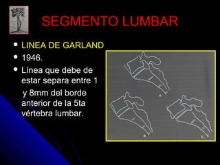 SSEEGGMMEENNTTOO LLUUMMBBAARR 
 LLIINNEEAA DDEE GGAARRLLAANNDD 
 11994466.. 
 LLíínneeaa qquuee ddeebbee ddee 
eessttaarr sseeppaarraa eennttrree 11 
yy 88mmmm ddeell bboorrddee 
aanntteerriioorr ddee llaa 5ttaa 
vvéérrtteebbrraa lluummbbaarr.. 
 
