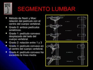 SSEEGGMMEENNTTOO LLUUMMBBAARR 
 MMééttooddoo ddee NNaasshh yy MMooee:: 
rreellaacciióónn ddeell ppeeddííccuulloo ccoonn eell 
cceennttrroo ddeell ccuueerrppoo vveerrtteebbrraall.. 
 GGrraaddoo 00:: aammbbooss ppeeddííccuullooss 
ssiimmééttrriiccooss.. 
 GGrraaddoo 11:: ppeeddííccuulloo ccoonnvveexxoo 
ddeessppllaazzaaddoo ddeell llaaddoo ddeell 
ccuueerrppoo vveerrtteebbrraall.. 
 GGrraaddoo 22:: rroottaacciióónn eennttrree 11 yy 33 
 GGrraaddoo 33:: ppeeddííccuulloo ccoonnvveexxoo eenn 
eell cceennttrroo ddeell ccuueerrppoo vveerrtteebbrraall.. 
 GGrraaddoo 44:: ppeeddííccuulloo ccoonnvveexxoo hhaa 
eexxcceeddiiddoo llaa llíínneeaa mmeeddiiaa 
 