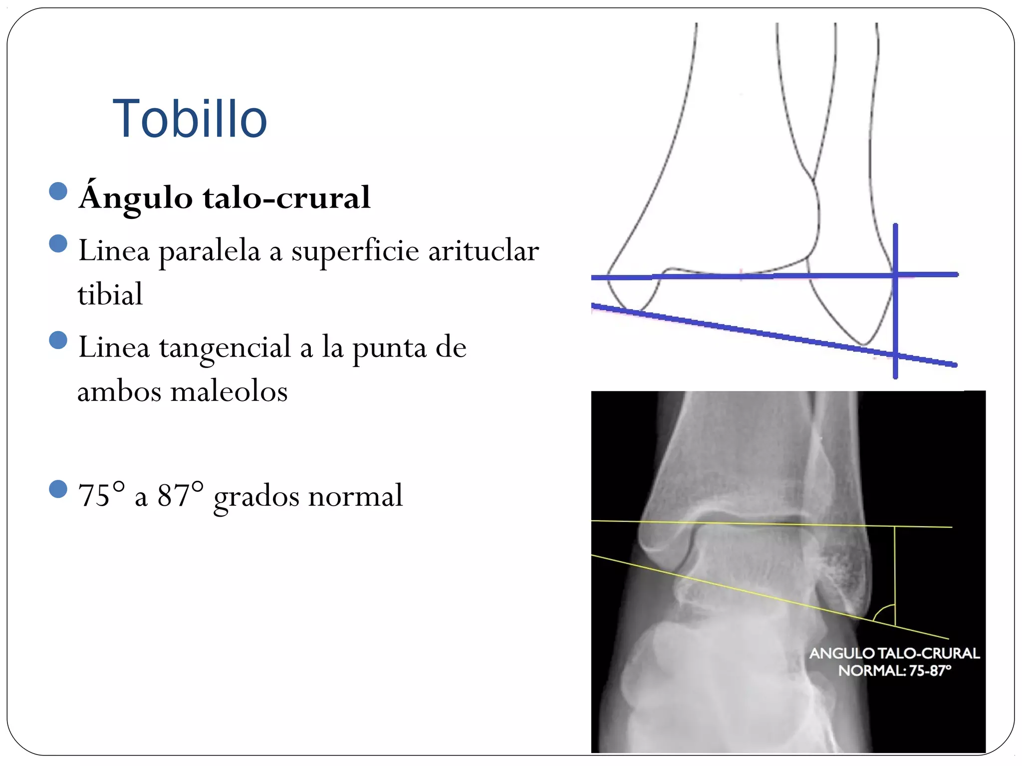 Angulo Tobillo Mediciones Radiográficas de Tobillo | PPT