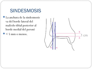 SINDESMOSIS
La anchura de la sindesmosis
va del borde lateral del
maléolo tibial posterior al
borde medial del peroné
< 5 mm o menos.
 