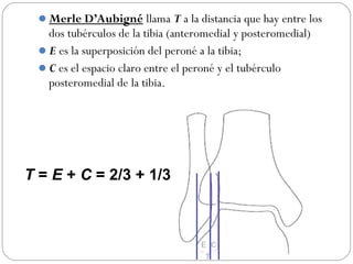 Merle D’Aubigné llama T a la distancia que hay entre los
dos tubérculos de la tibia (anteromedial y posteromedial)
E es la superposición del peroné a la tibia;
C es el espacio claro entre el peroné y el tubérculo
posteromedial de la tibia.
T = E + C = 2/3 + 1/3
 