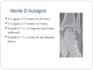 Merle D’Aubigné
E es igual a 2/3 (entre 8 a 10 mm)
C es igual a 1/3 (entre 1a 3 mm).
Cuando E = C, se sospecha una Lesión
sindesmal
Cuando E < C, se trata de una diastasis
franca.
T
C E
 