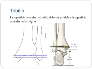 Tobillo
La superficie articular de la tibia debe ser paralela a la superficie
articular del astrágalo
 