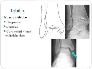 Tobillo
Espacio articular
Congruente
Simétrico
Claro medial <4mm
(lesión deltoideo)
 