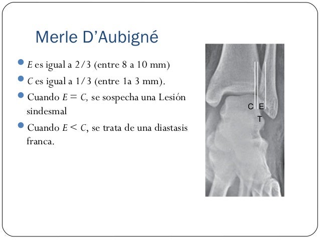 Mediciones Radiográficas de Tobillo