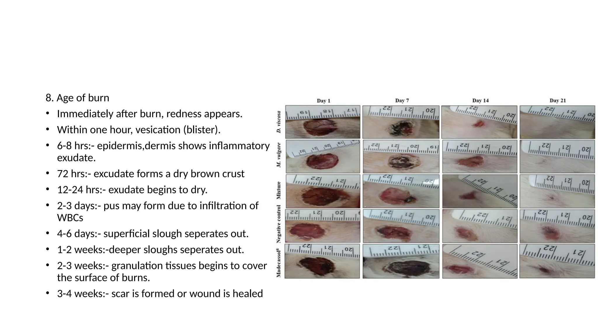 8. Age of burn
• Immediately after burn, redness appears.
• Within one hour, vesication (blister).
• 6-8 hrs:- epidermis,dermis shows inflammatory
exudate.
• 72 hrs:- excudate forms a dry brown crust
• 12-24 hrs:- exudate begins to dry.
• 2-3 days:- pus may form due to infiltration of
WBCs
• 4-6 days:- superficial slough seperates out.
• 1-2 weeks:-deeper sloughs seperates out.
• 2-3 weeks:- granulation tissues begins to cover
the surface of burns.
• 3-4 weeks:- scar is formed or wound is healed
 
