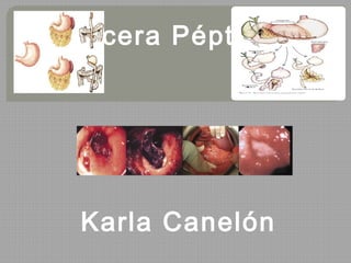 Ulcera Péptica
Karla Canelón
 