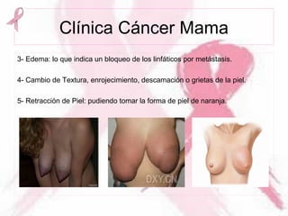 Clínica Cáncer Mama
3- Edema: lo que indica un bloqueo de los linfáticos por metástasis.
4- Cambio de Textura, enrojecimiento, descamación o grietas de la piel.
5- Retracción de Piel: pudiendo tomar la forma de piel de naranja.
 