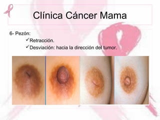 Clínica Cáncer Mama
6- Pezón:
Retracción.
Desviación: hacia la dirección del tumor.
 