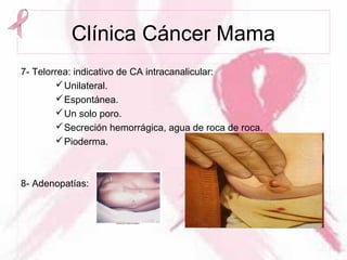 Clínica Cáncer Mama
7- Telorrea: indicativo de CA intracanalicular:
Unilateral.
Espontánea.
Un solo poro.
Secreción hemorrágica, agua de roca de roca.
Pioderma.
8- Adenopatías:
 