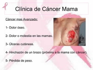 Clínica de Cáncer Mama
Cáncer mas Avanzado:
1- Dolor óseo.
2- Dolor o molestia en las mamas.
3- Úlceras cutáneas.
4- Hinchazón de un brazo (próximo a la mama con cáncer).
5- Pérdida de peso.
 