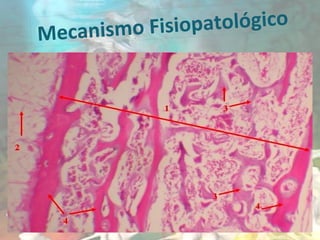 Mecanismo Fisiopatológico
 