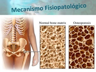 Mecanismo Fisiopatológico
 
