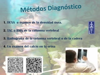 Métodos Diagnóstico
1. DEXA o examen de la densidad ósea.
2. TAC o RMN de la columna vertebral
3. Radiografía de la columna vertebral o de la cadera
4. Un examen del calcio en la orina
 