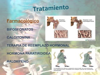 Tratamiento
Farmacológico
BIFOSFONATOS
CALCITONINA
TERAPIA DE REEMPLAZO HORMONAL
HORMONA PARATIROIDEA
RALOXIFENO
 