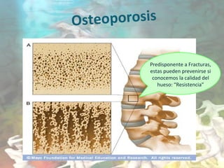 Osteoporosis
Predisponente a Fracturas,
estas pueden prevenirse si
conocemos la calidad del
hueso: “Resistencia”
 