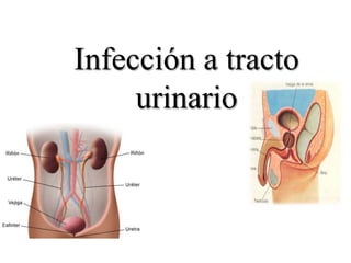Infección a tracto
urinario

 