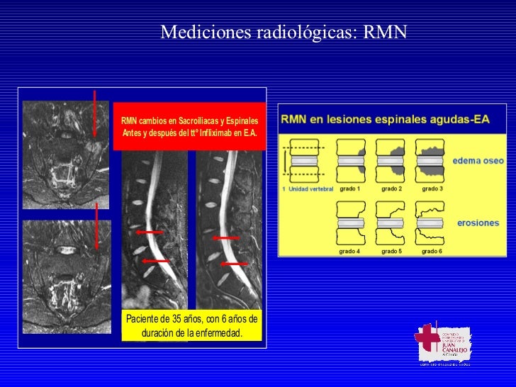 Que tranquiliza los medios de la osteocondrosis
